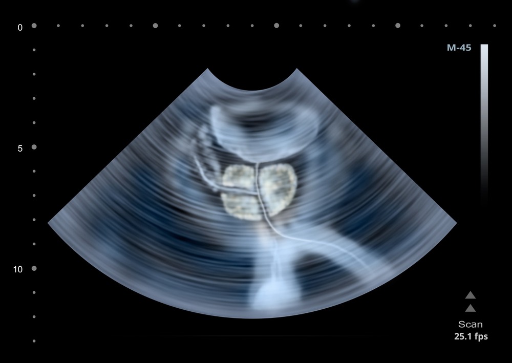 Prostate Scan (Transabdominal)